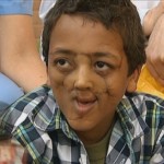 Ethiopian boy Sisay Taye received new nose after hyena attack