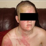 Teen Allegedly Throws Boiling Water On Girl For Unfriending Him On Facebook